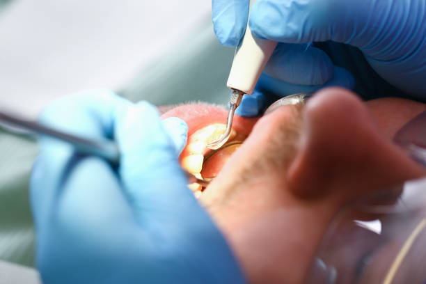 Best Emergency Wisdom Teeth Removal in Dalton, OH